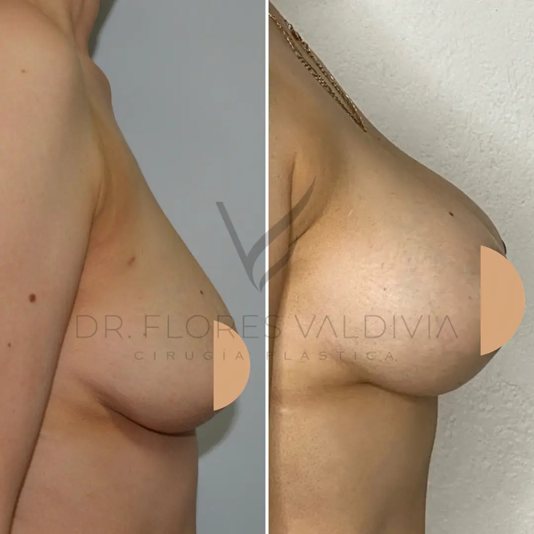 Breast Augmentation in Tijuana