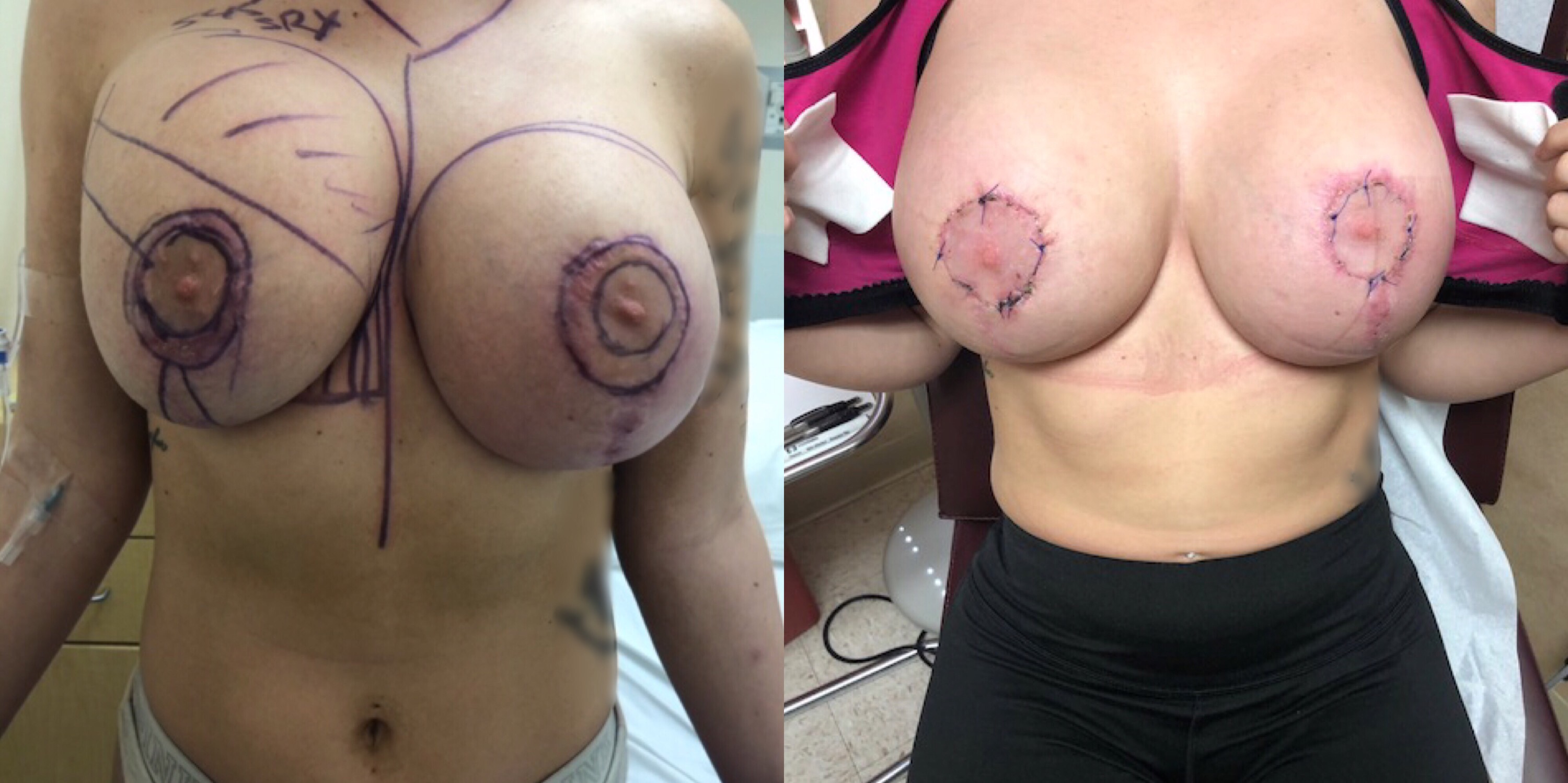 Correcting Double Bubble Breast Deformities