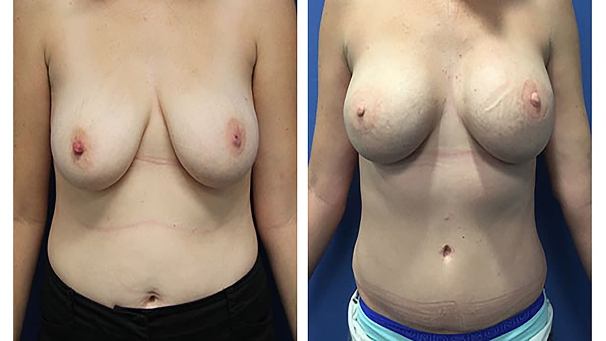Double Bubble Deformity: Causes Treatment Prevention