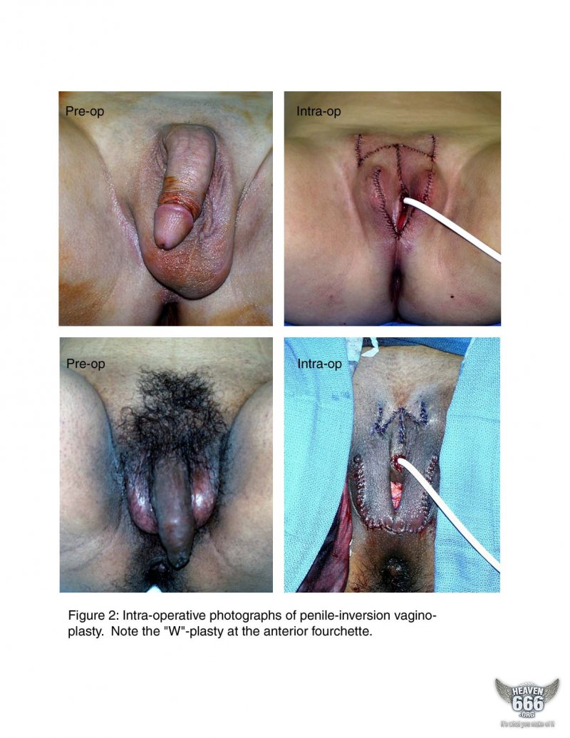 Sex change male to female gender reassignment