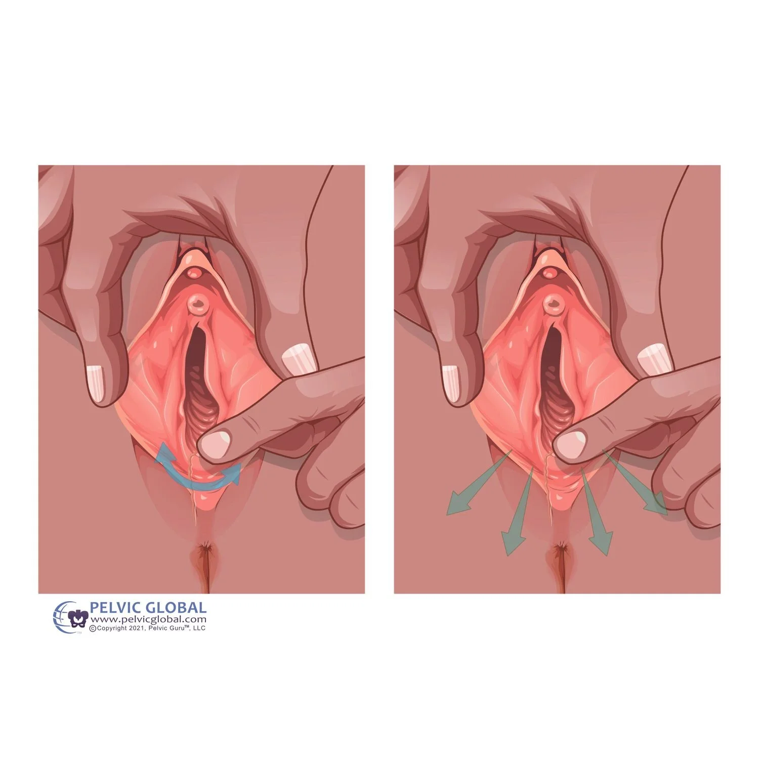 Perineal stretching during pregnancy: does this help prevent tearing with vaginal birth? Bethanys Hansen LLC