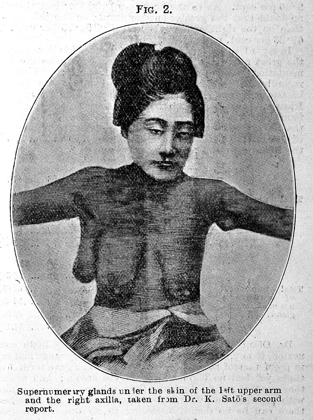 Accessory breast