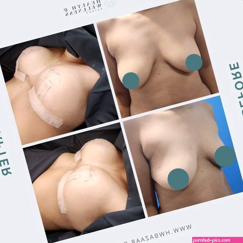 Breast Lift In Tijuana