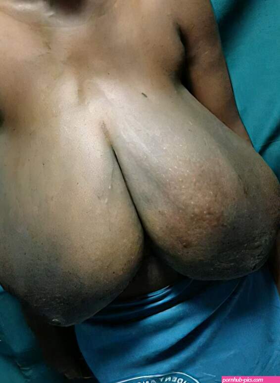 Breast hypertrophy