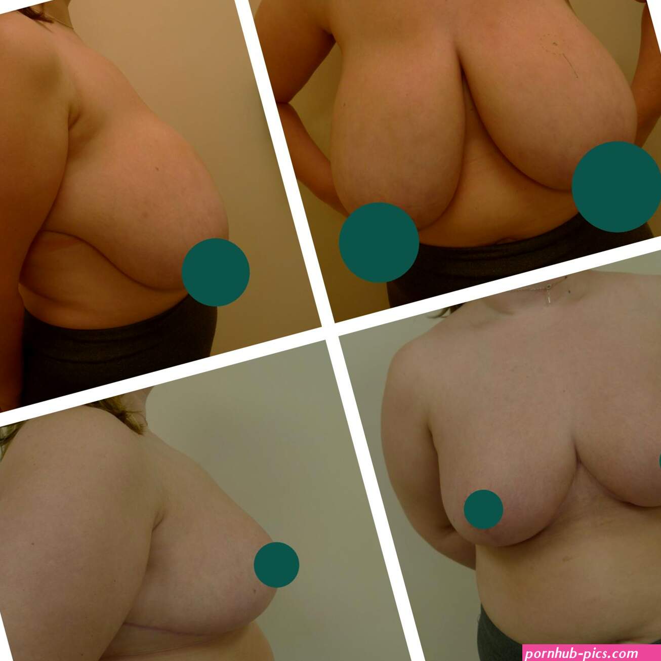 Breast Reduction in Leeds