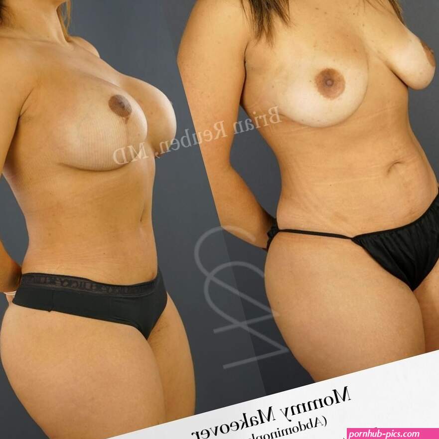 Mommy Makeover Transformation Photos