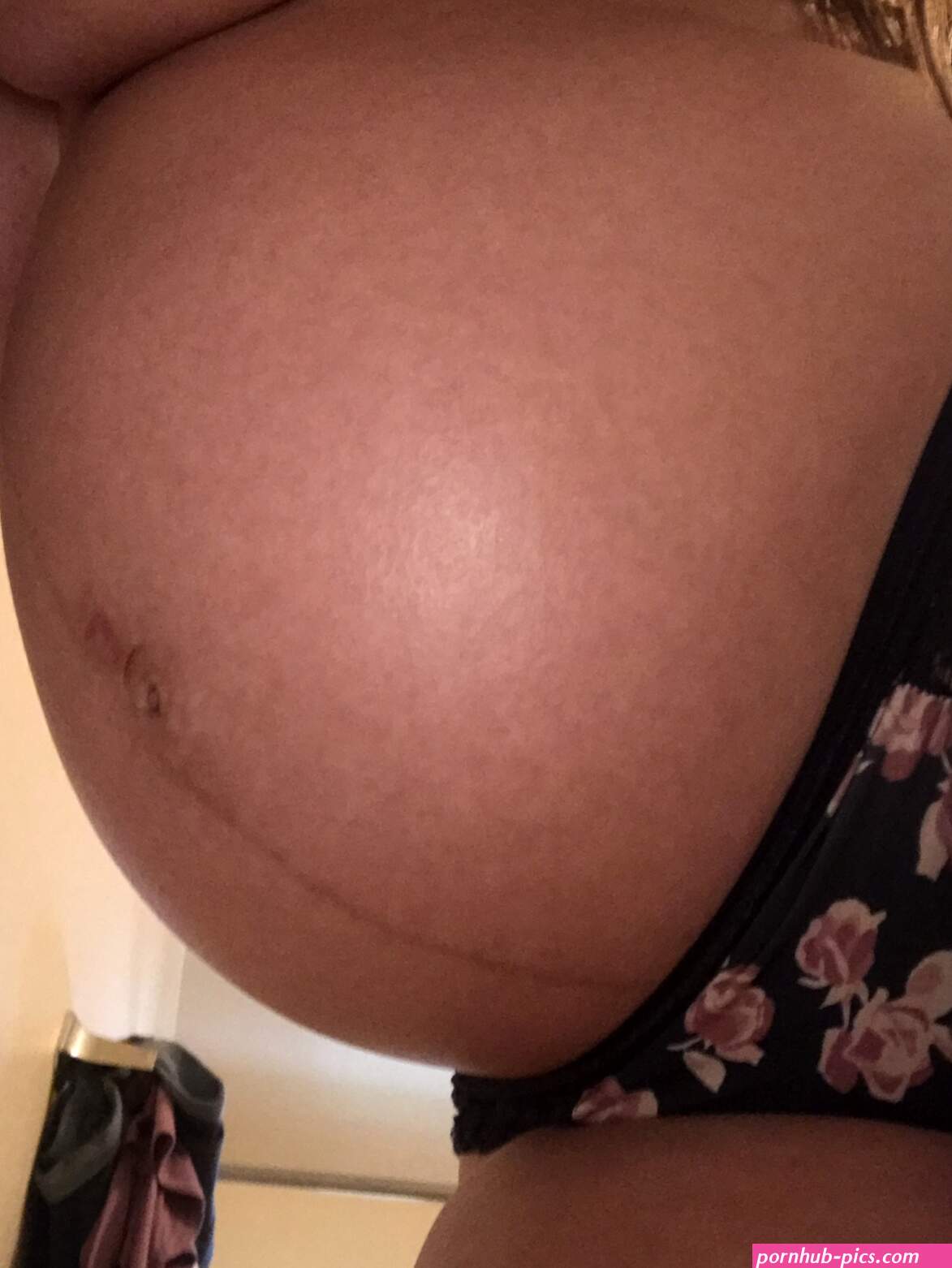 If you look closely I have that linea alba line on my boobs too Ÿ Porn Pic