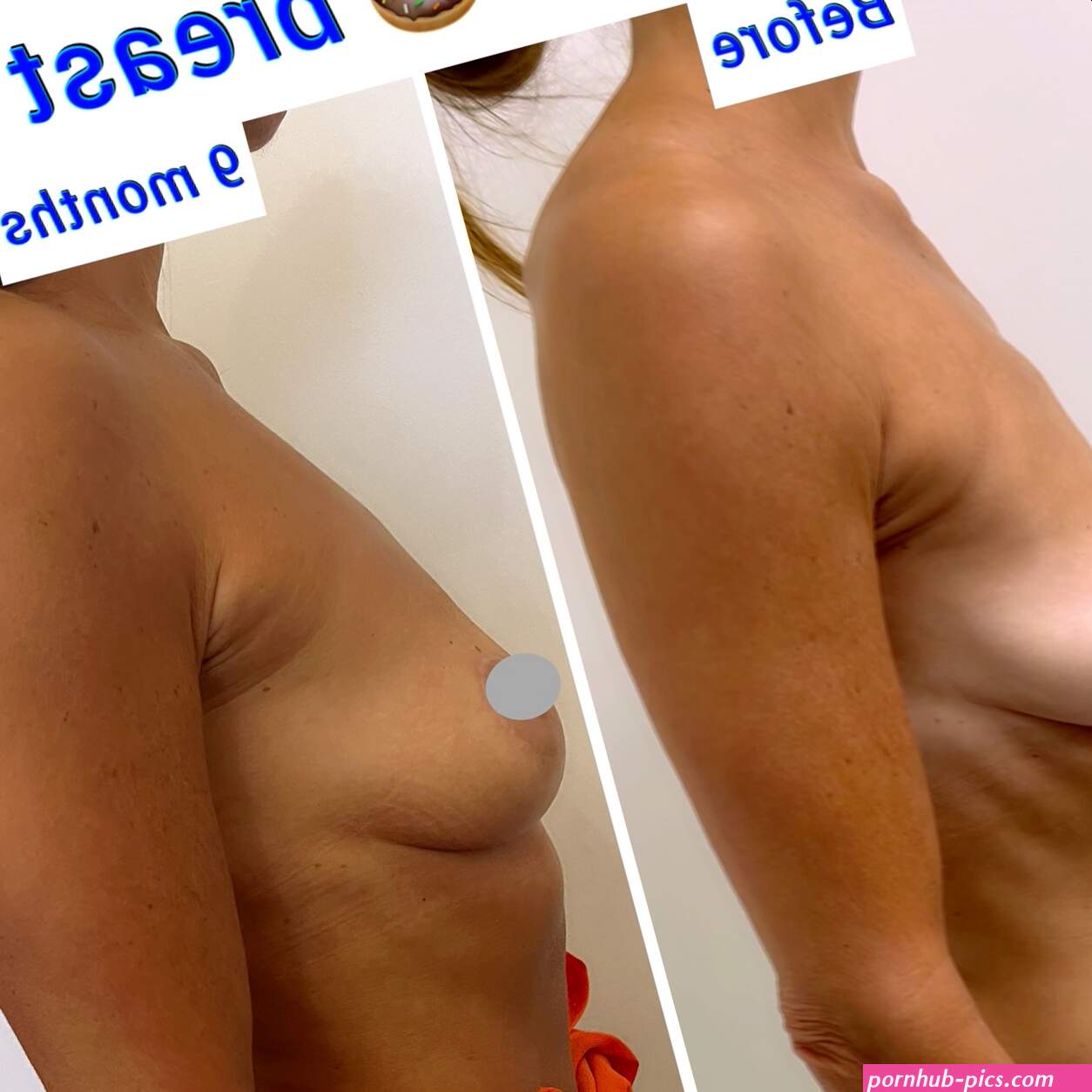 Mastopexy for Small Breasts: 5 Facts You Need to Know