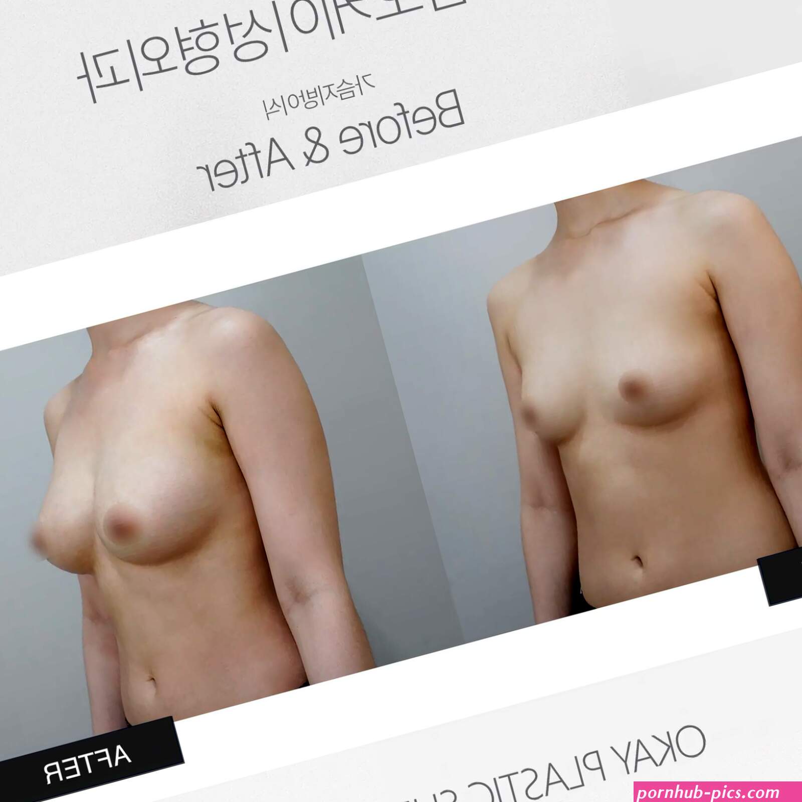 Micromastia in Korea: Breast Augmentation Procedures as Effective Solutions