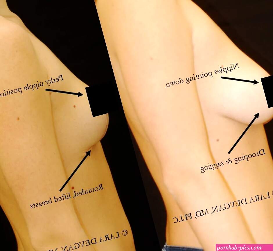 Breast lift mastopexy to restore the breasts to a perky position Lara Devgan MD MPH FACS