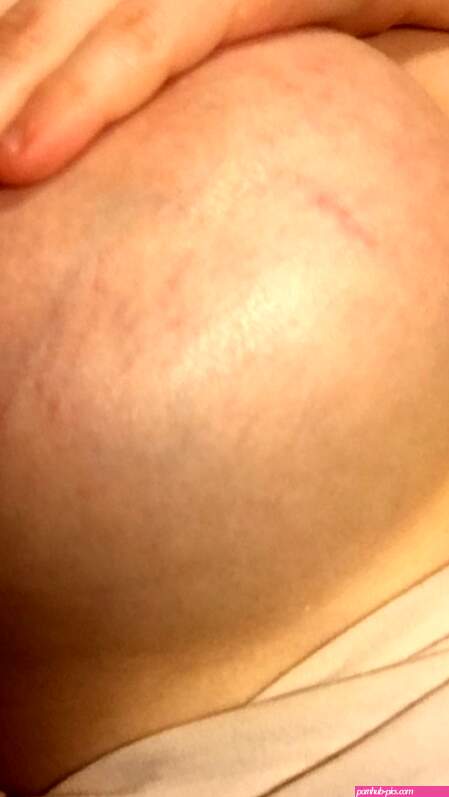 TMI Stretch Marks on Boobs?