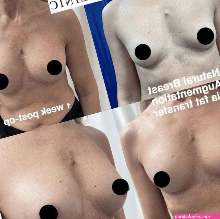 Breast Augmentation: Implants vs Fat Transfer