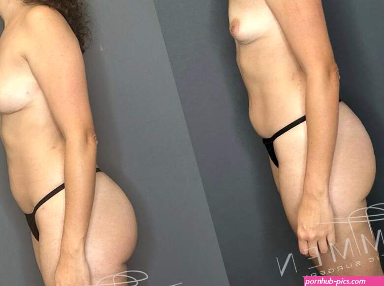 Natural Breast Augmentation Before Afters