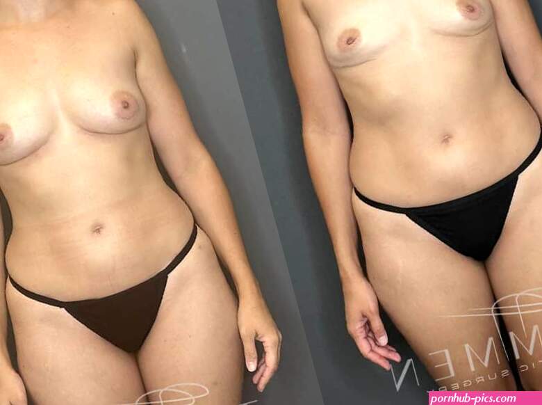 Natural Breast Augmentation Tampa FL