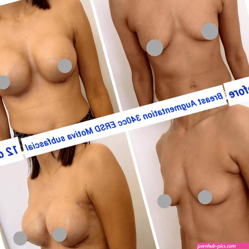 The Ideal Boob Job: The Art and Science of Choosing the Best Breast Implants for You