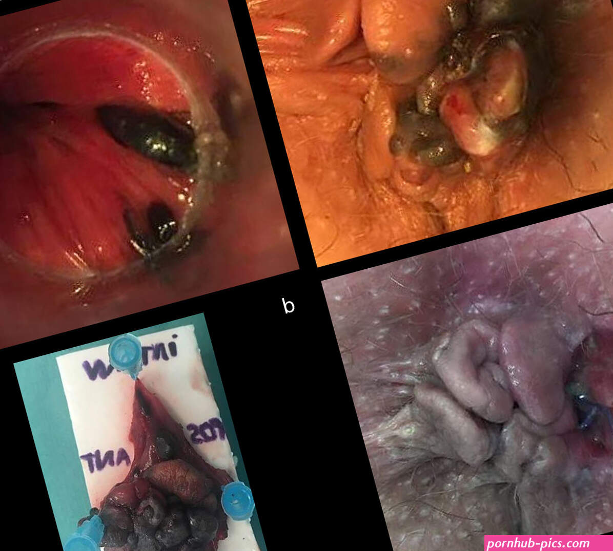 Melanoma anal una patologa radicalmente distinta al melanoma cutneo con un pronstico infausto