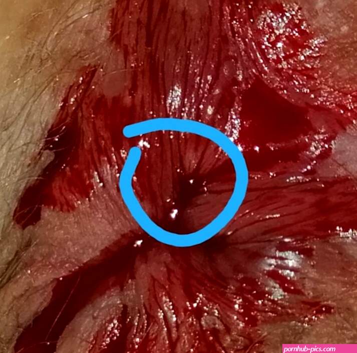 Bloed anus