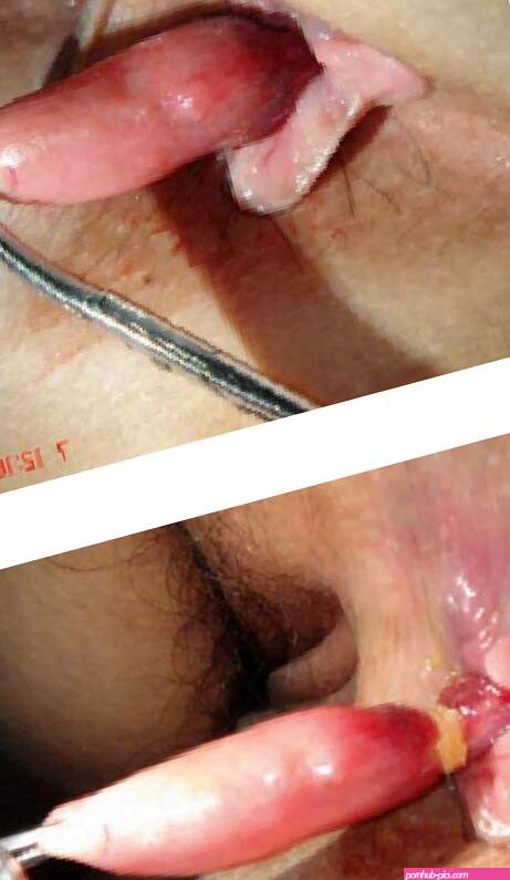 Lesiones Fibroepiteliales del Canal Anal: alternativa terapéutica con Ligadura de Bandas Elsticas