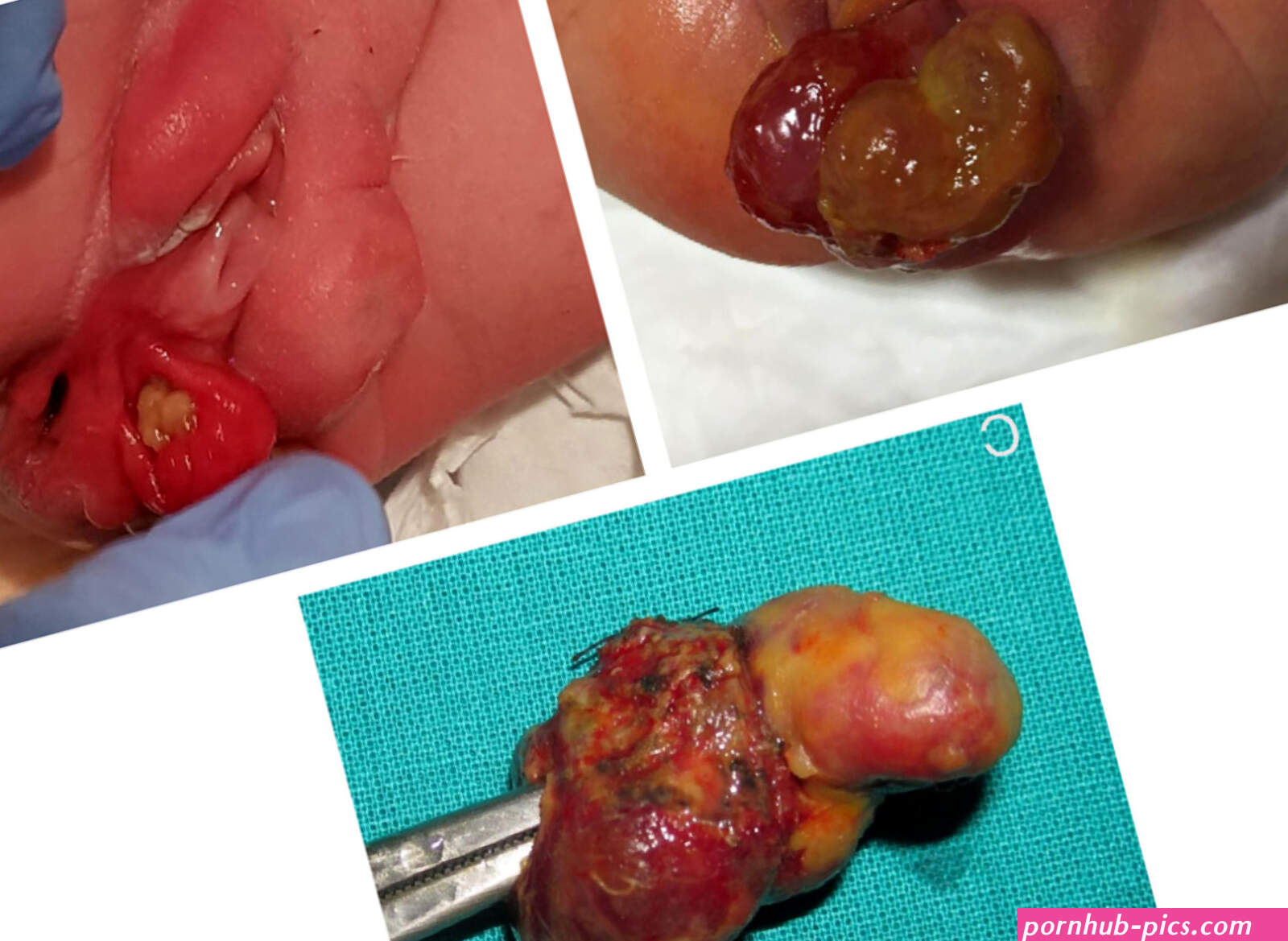 Perineal mass at birth