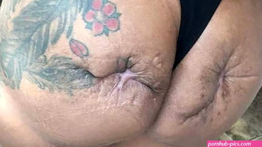 Botched Brazilian butt lift leaves mom with lopsided rear after she was close to dying