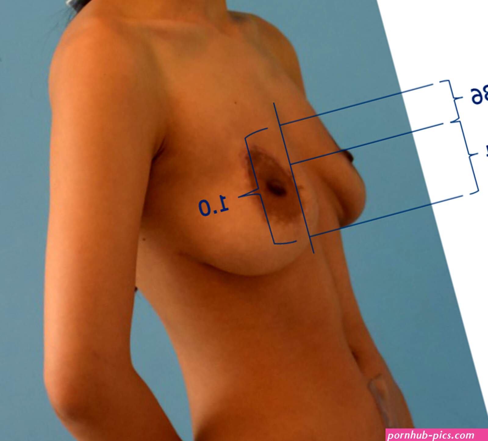 Expander implantation for correction of high-riding nipple with enlarged nipple-areola complex using revision mastopexy: A case report