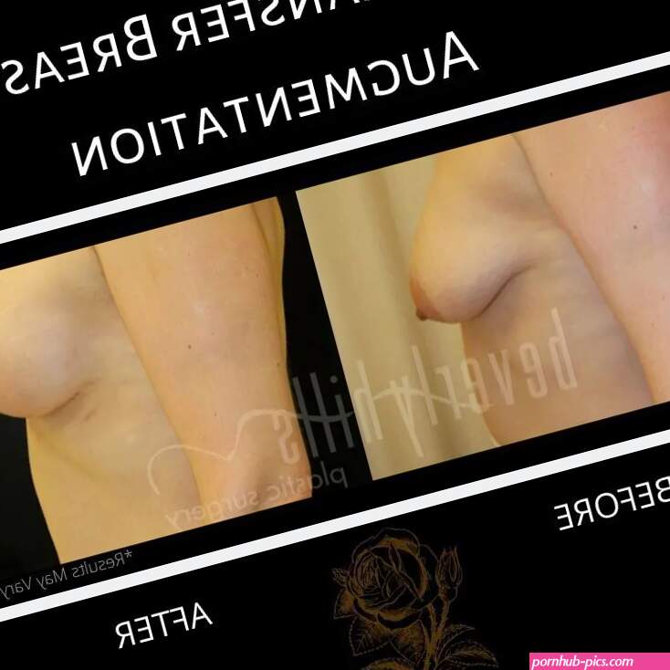 Rejuvenate Breasts With Fat Transfer