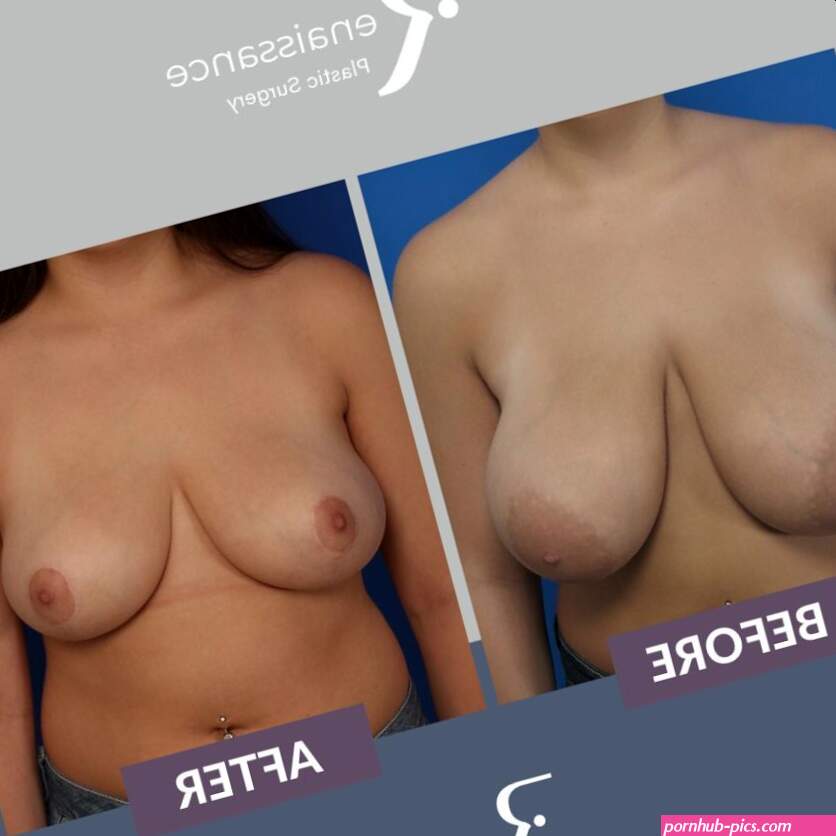 Breast Reduction
