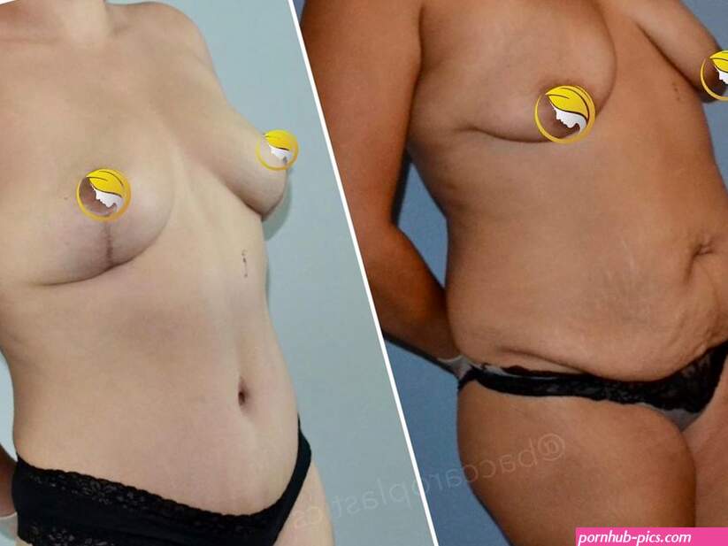 Before and After Plastic Surgery: Breast Lift