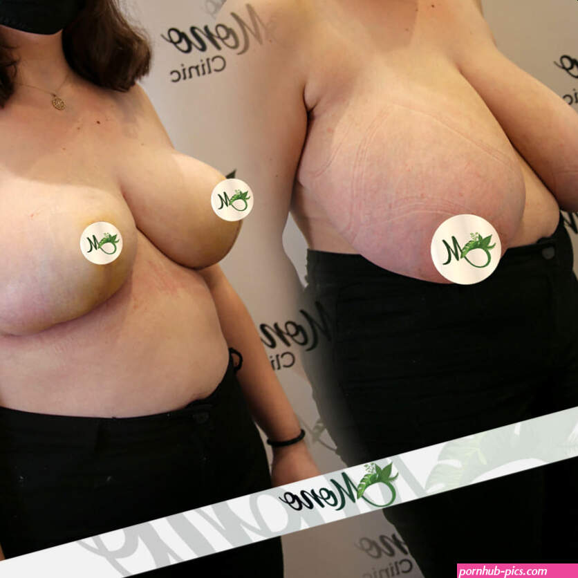 Breast Reduction Surgery Cost Turkey