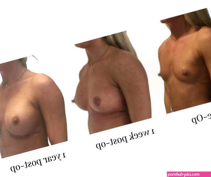 Breast Enlargement and Implants