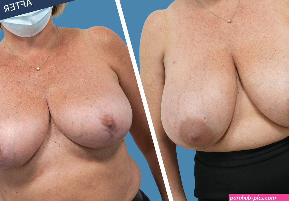 Breast Reduction Surgery Info Insights Anthony Macquillan