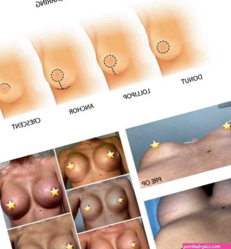 Breast Surgery Scarring Guide