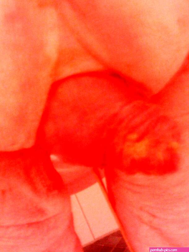 File:Rectal prolaps.jpg