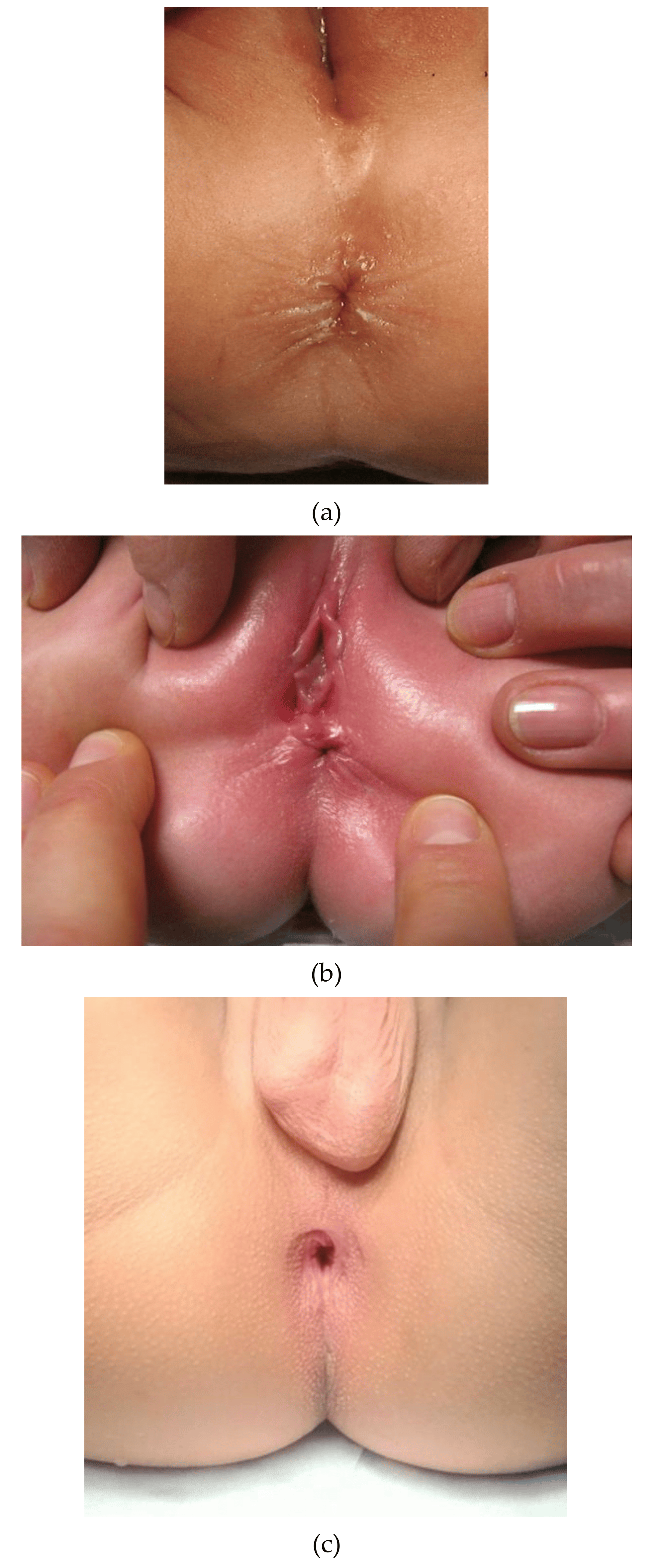 Clinical Differentiation between a Normal Anus Anterior Anus Congenital Anal Stenosis and Perineal Fistula: Definitions and ConsequencesThe ARM-Net Consortium Consensus