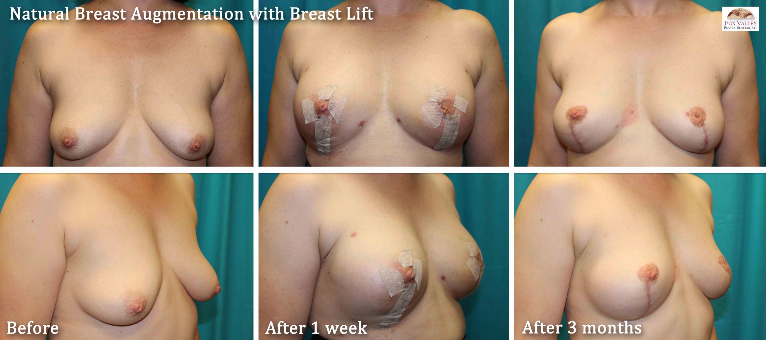Natural breast augmentation with fat transfer in Wisconsin