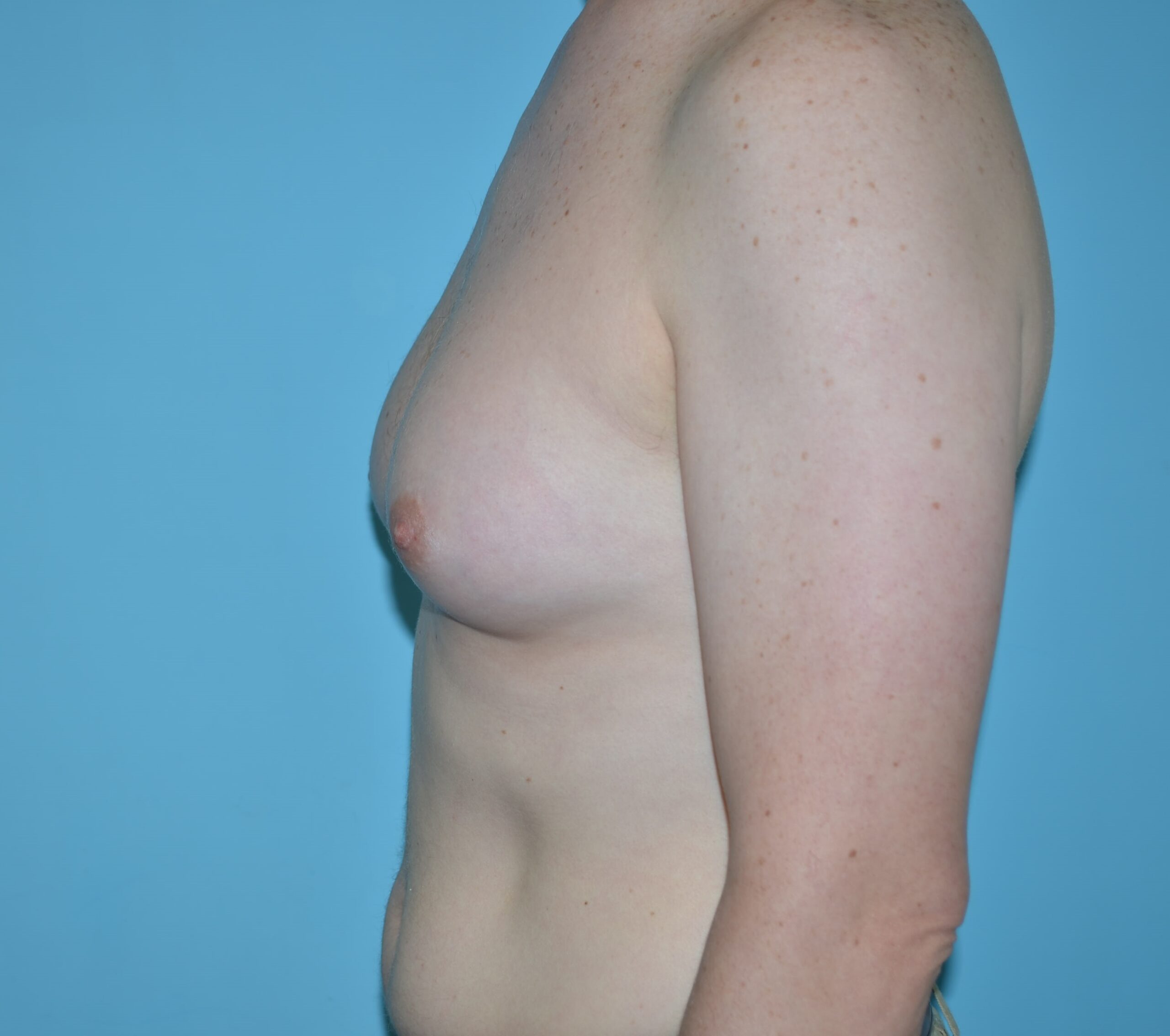 Before After Photos