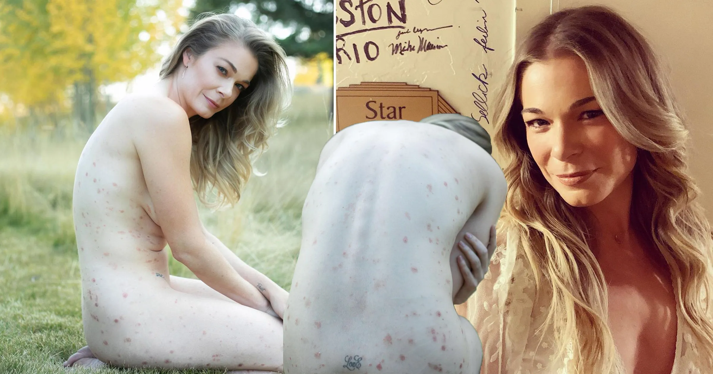 LeAnn Rimes overwhelmed after revealing psoriasis with naked photo