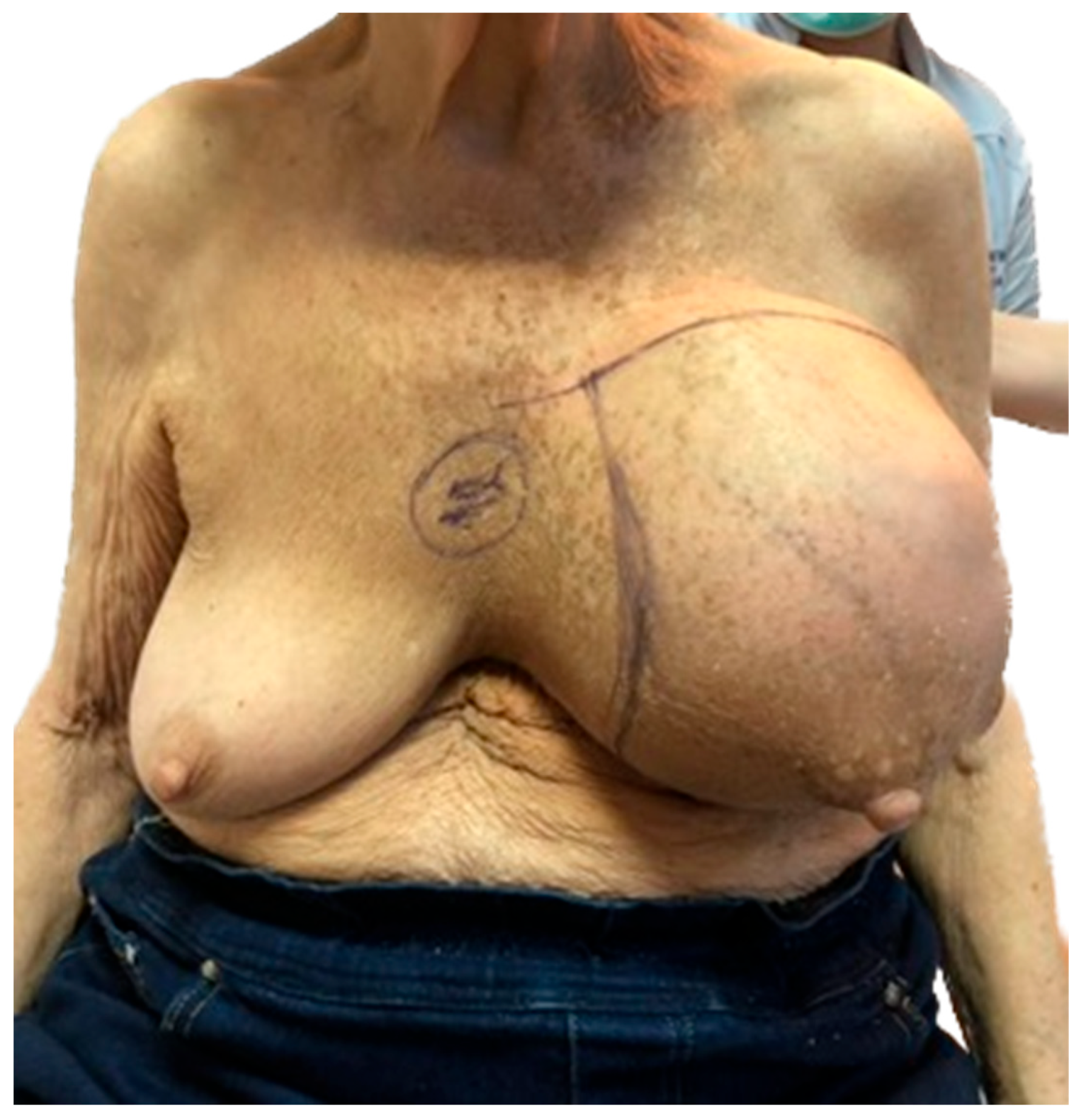 Extremely Rare Type of Breast CancerDedifferentiated Breast LiposarcomaDiagnosis and Treatment