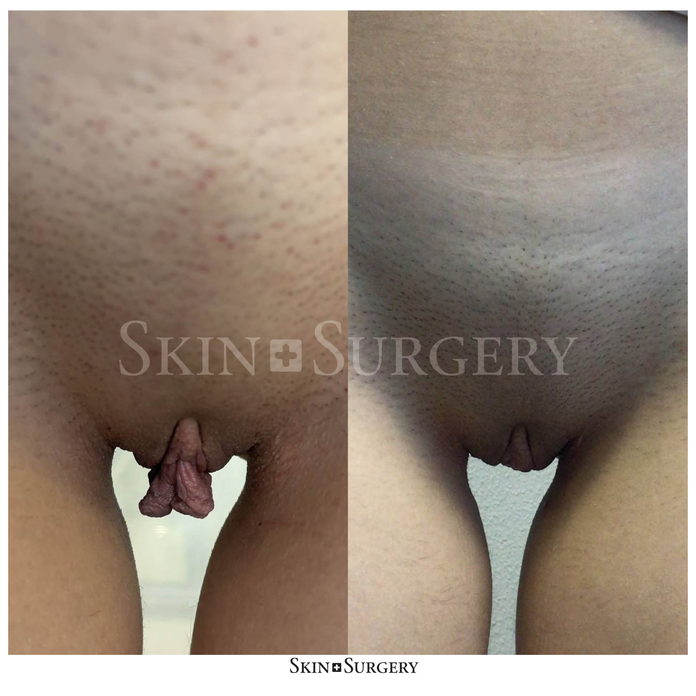 Labiaplasty