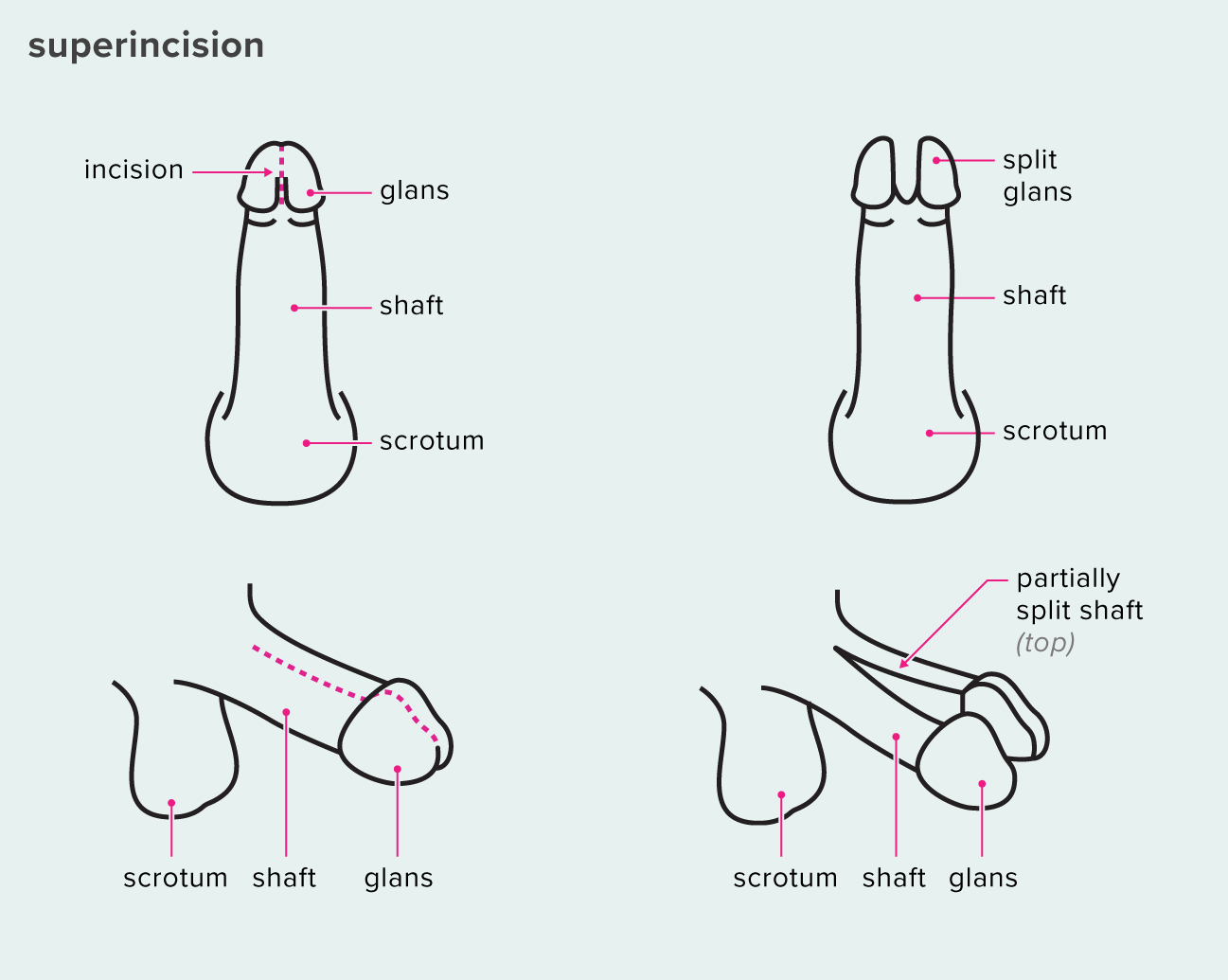 Penis Splitting: Techniques Safety Effect on Fertility and More