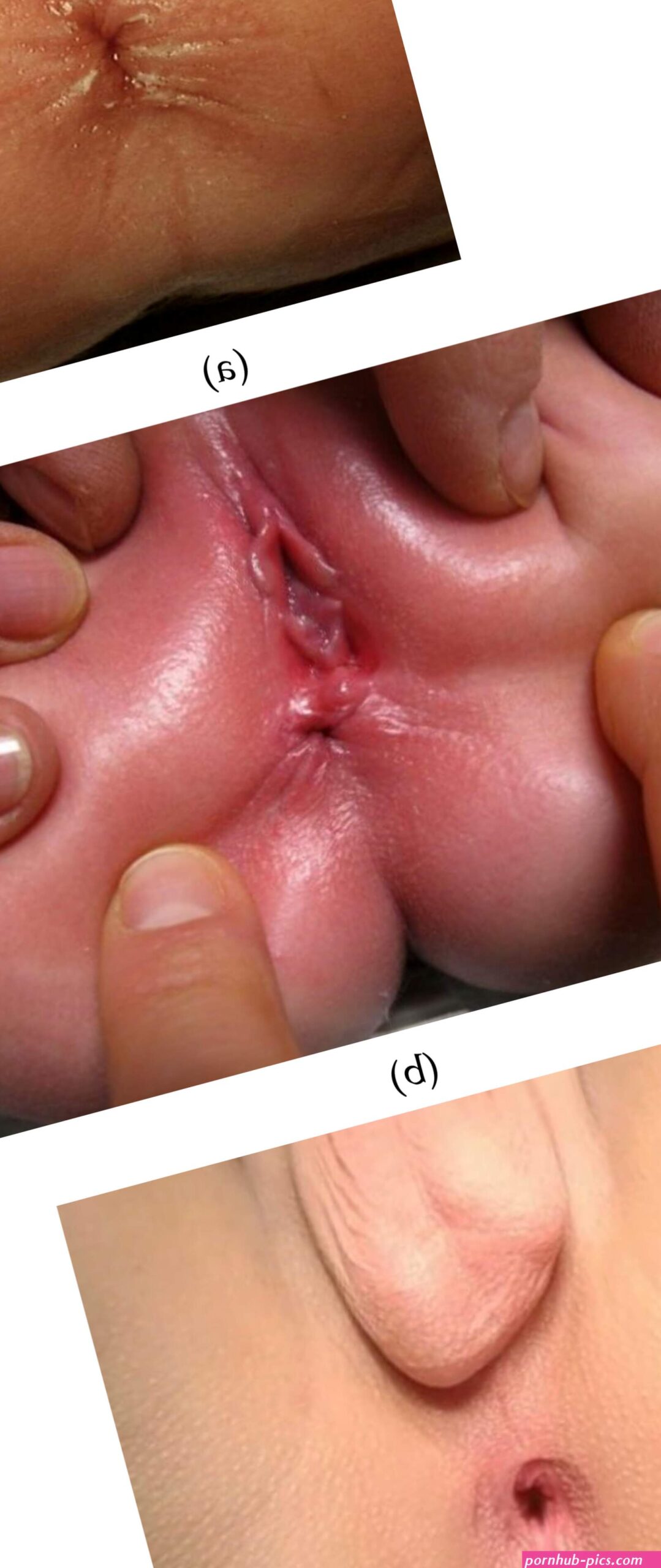 Clinical Differentiation between a Normal Anus Anterior Anus Congenital Anal Stenosis and Perineal Fistula: Definitions and ConsequencesThe ARM-Net Consortium Consensus